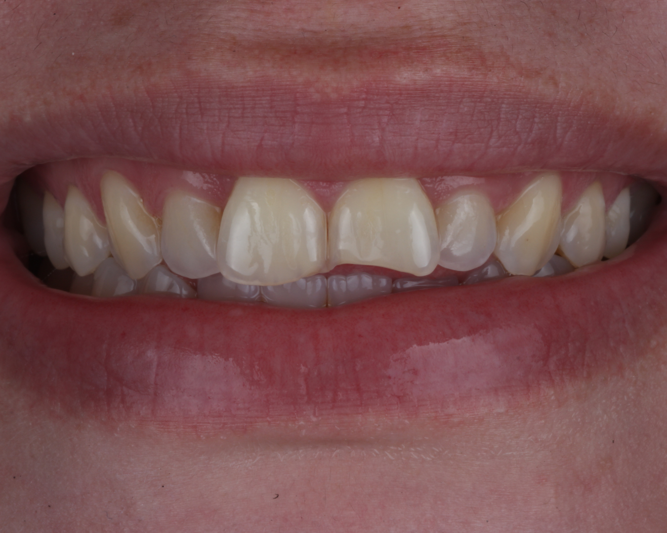 Antes - before smile