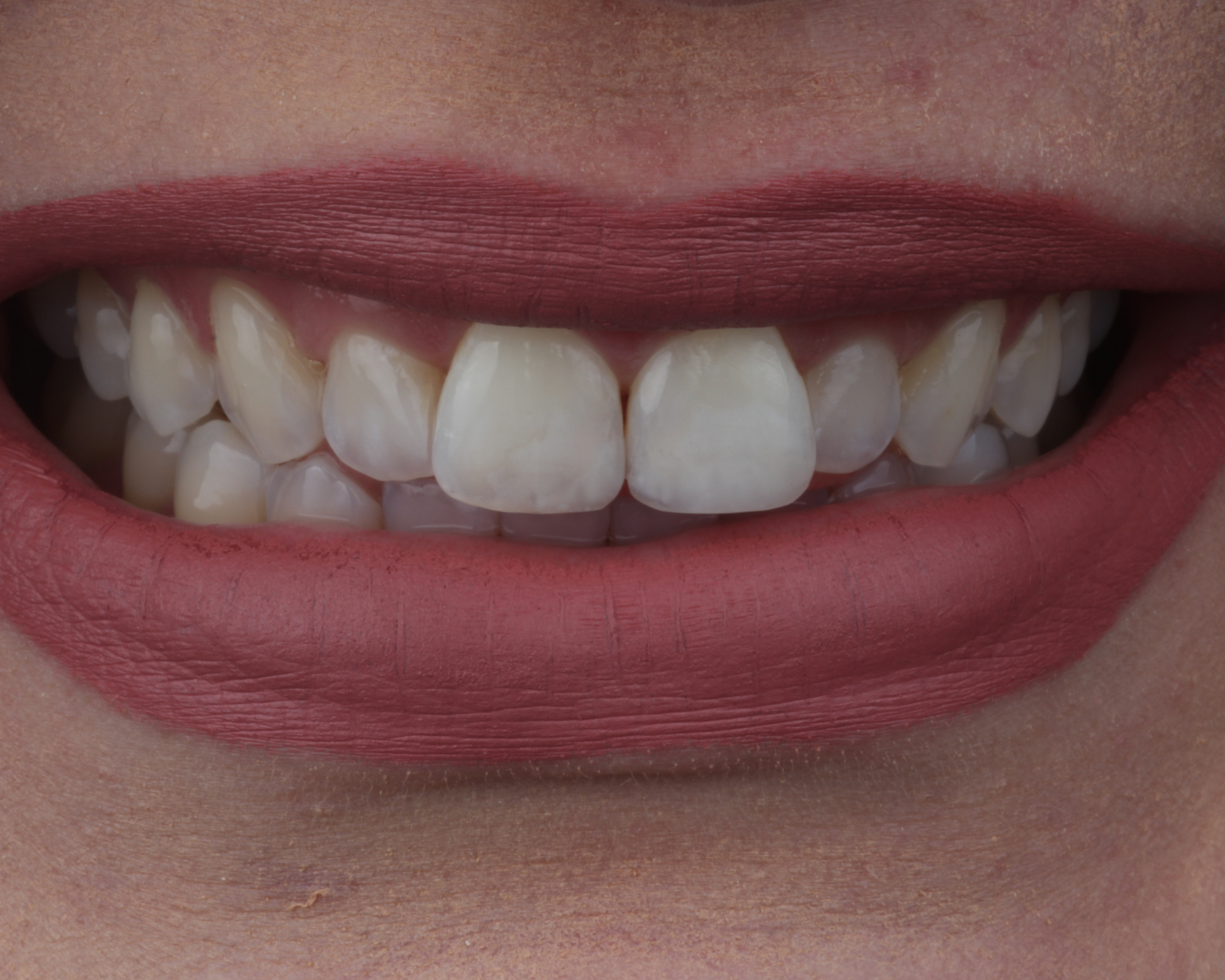 Depois - after smile