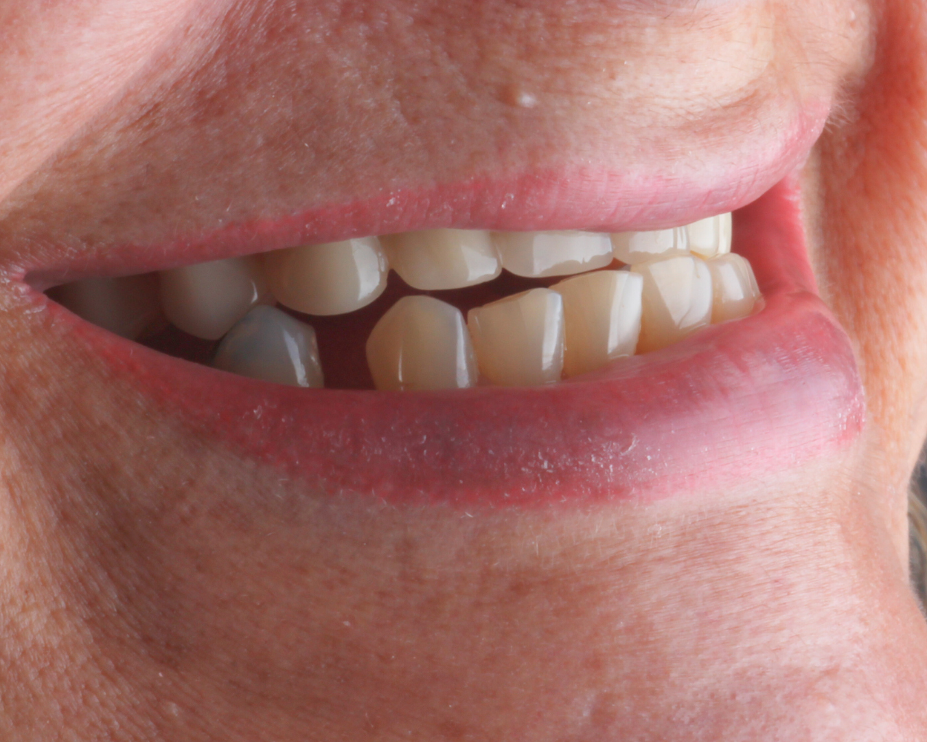 Antes - before smile