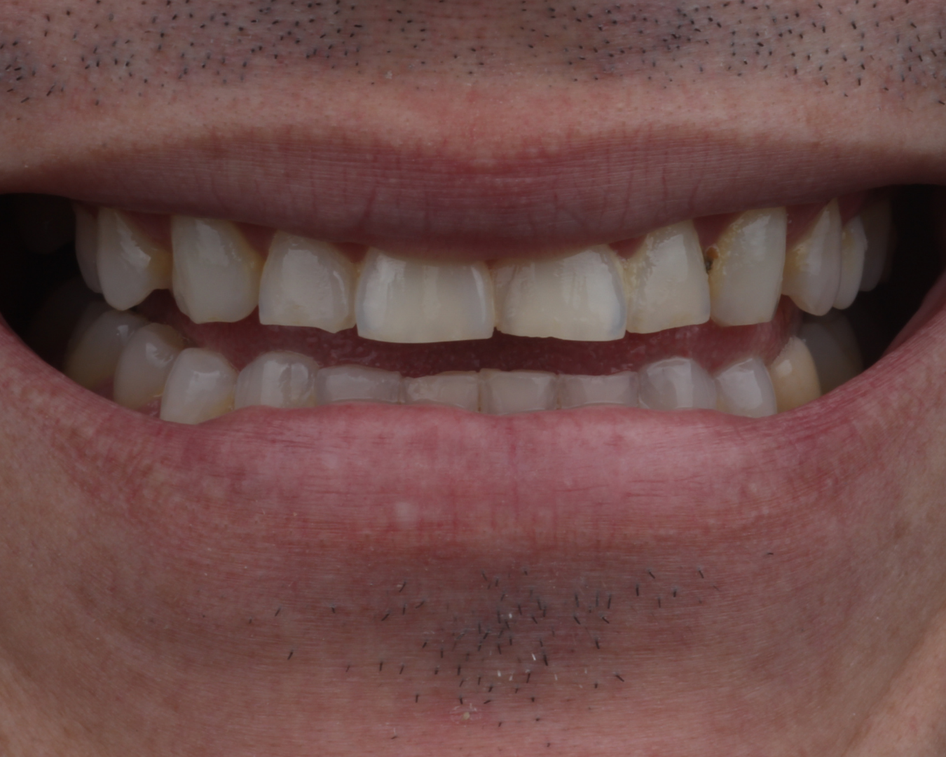 Antes - before smile