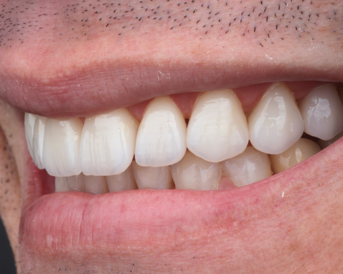 Depois - after smile