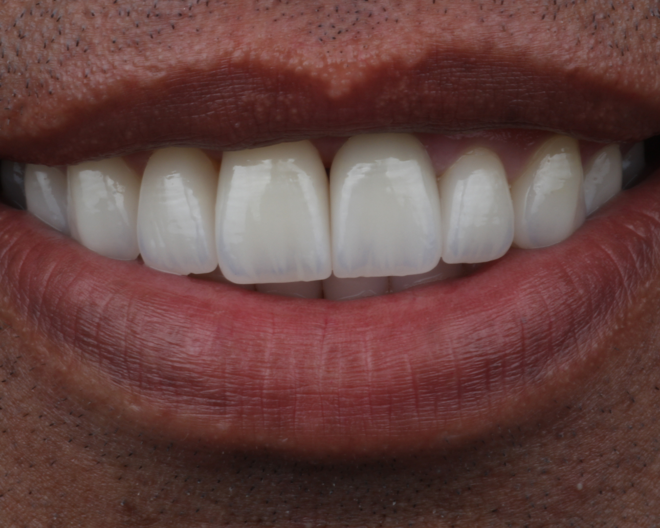 Depois - after smile