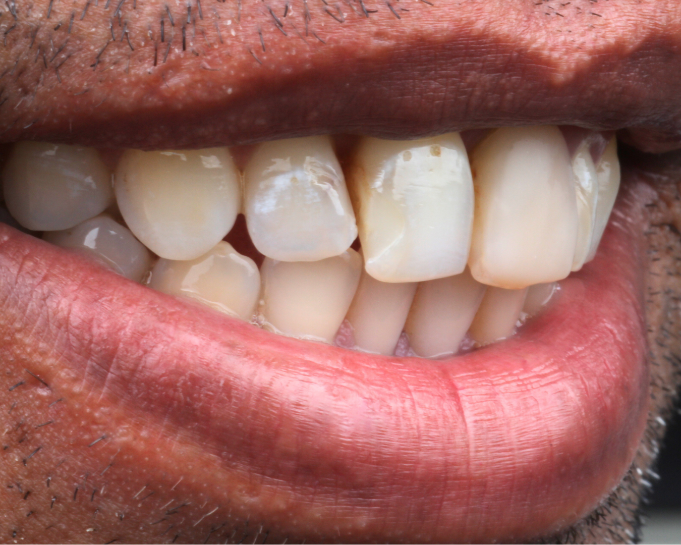 Antes - before smile