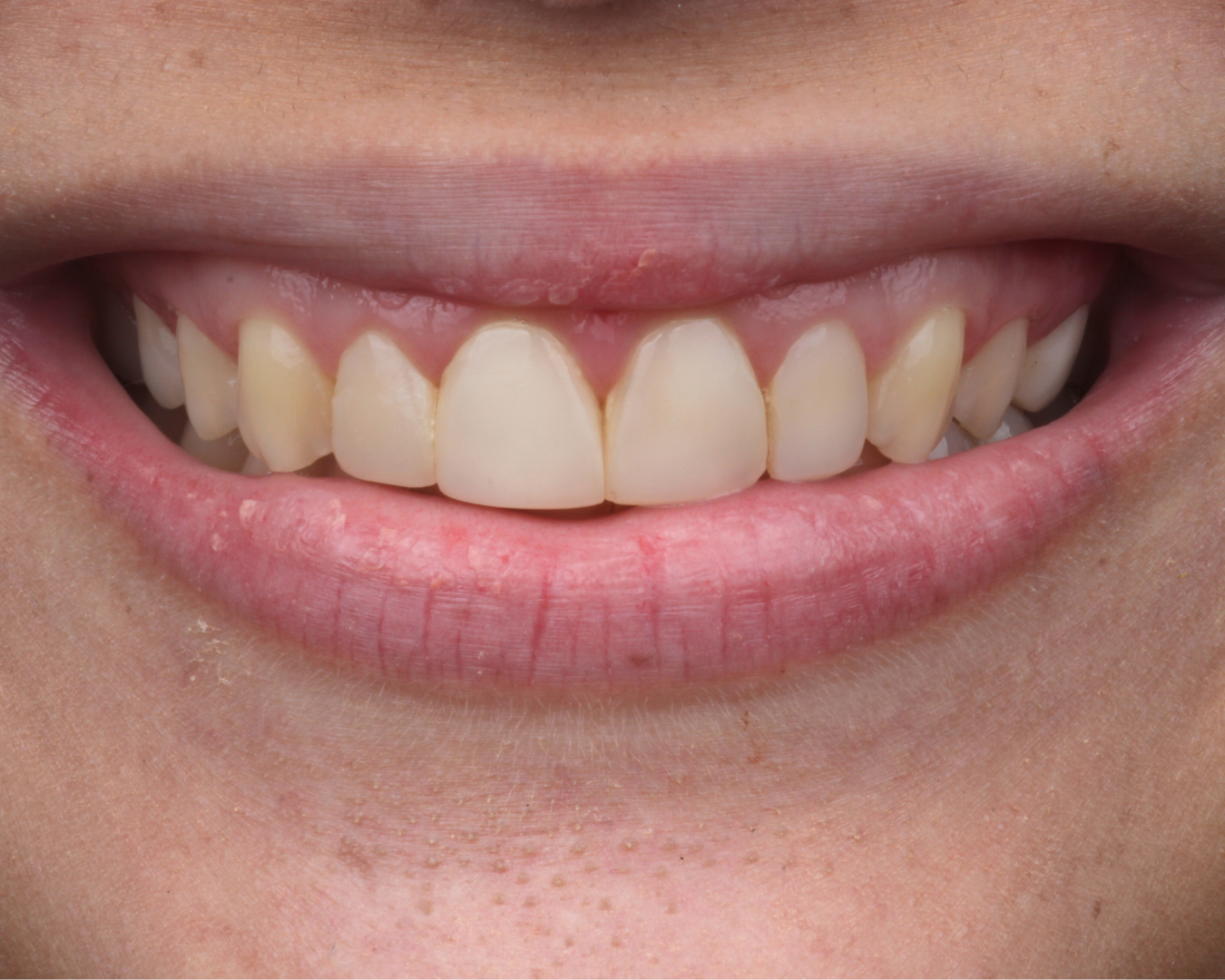 Antes - before smile