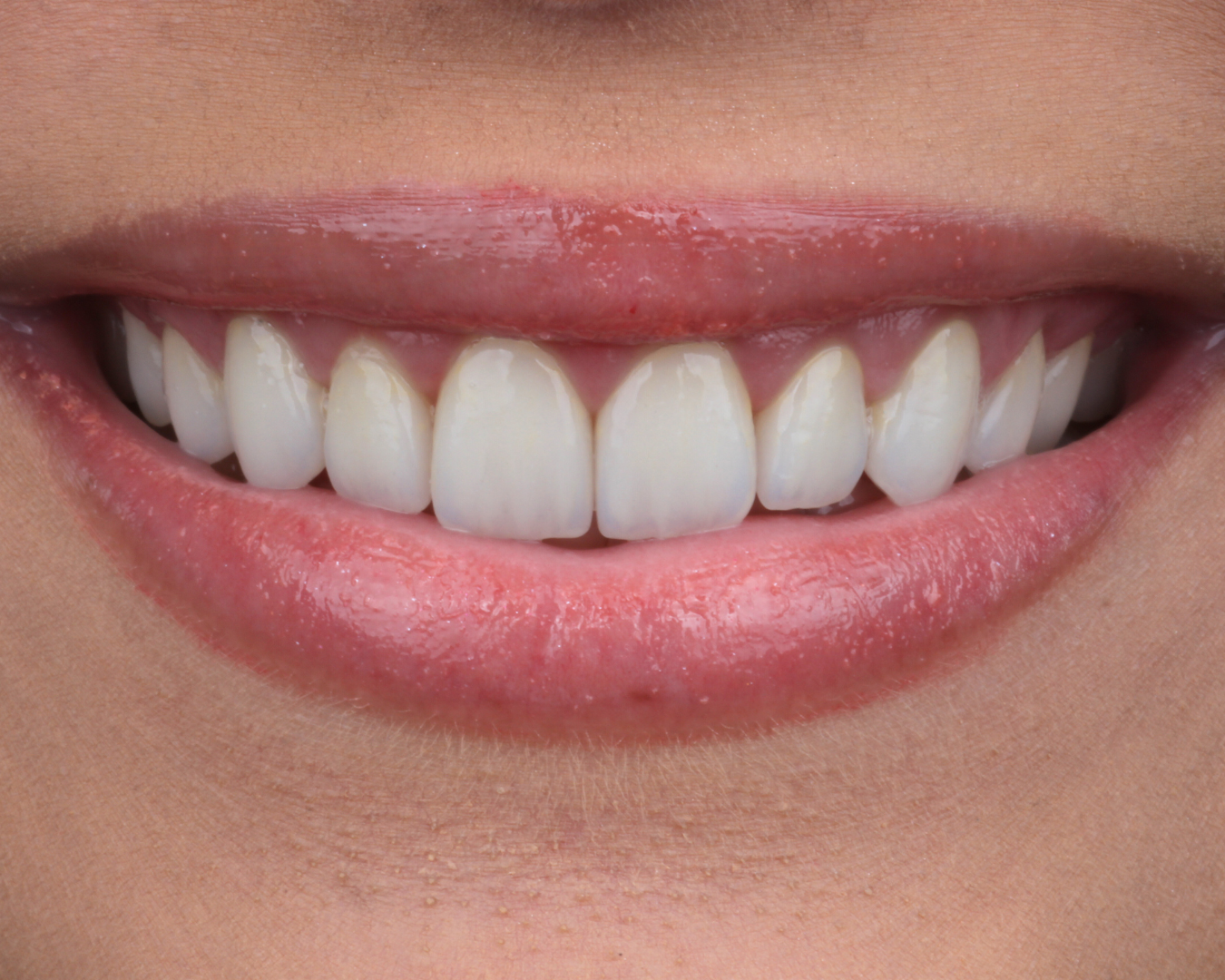 Depois - after smile