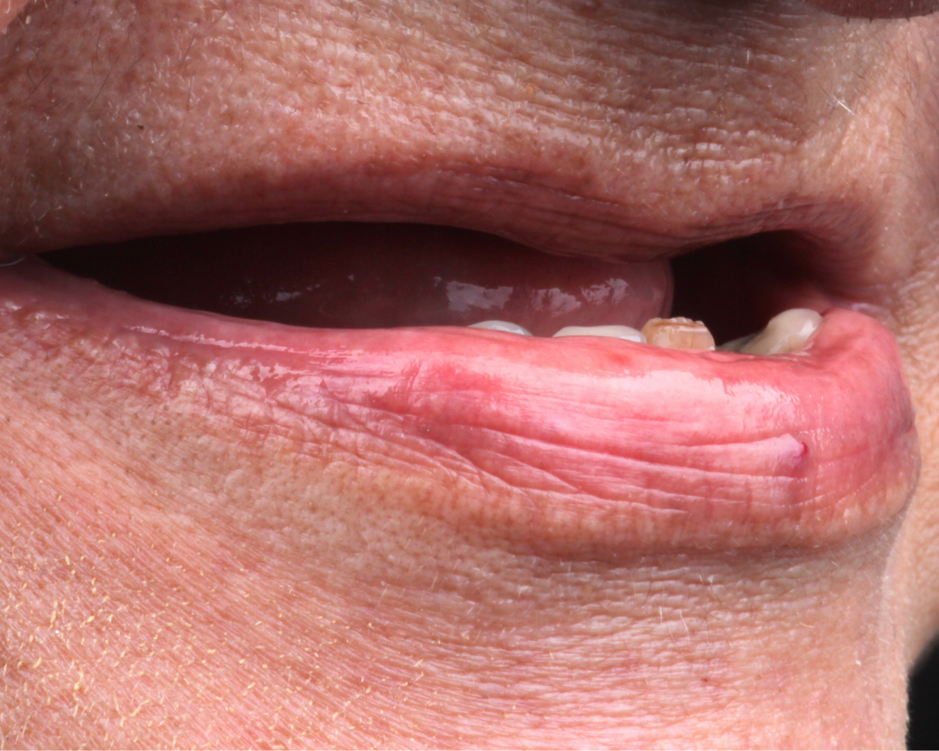 Antes - before smile