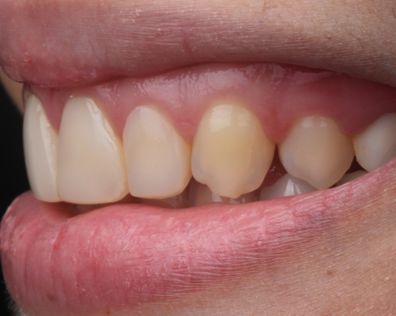 Antes - before smile