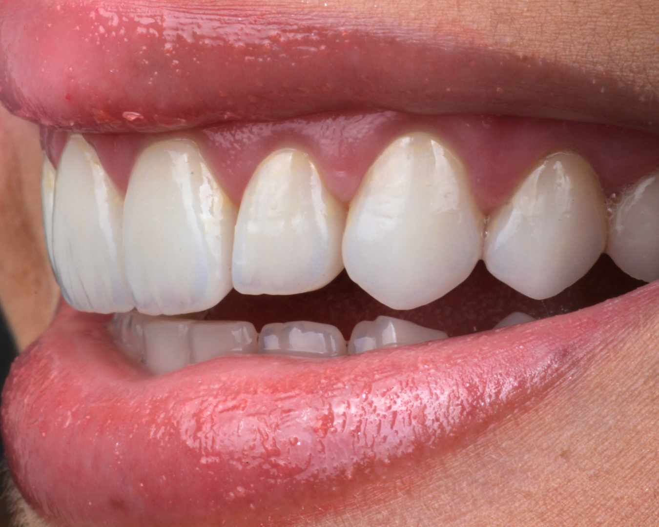 Depois - after smile