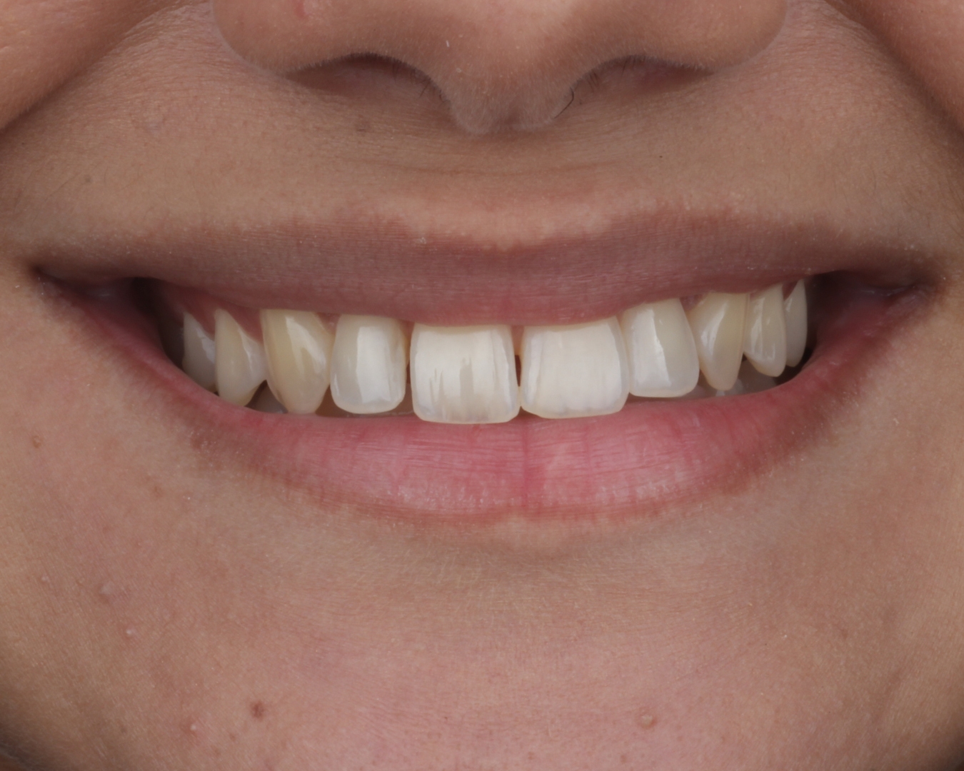 Antes - before smile