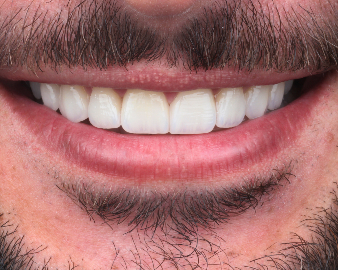 Depois - after smile