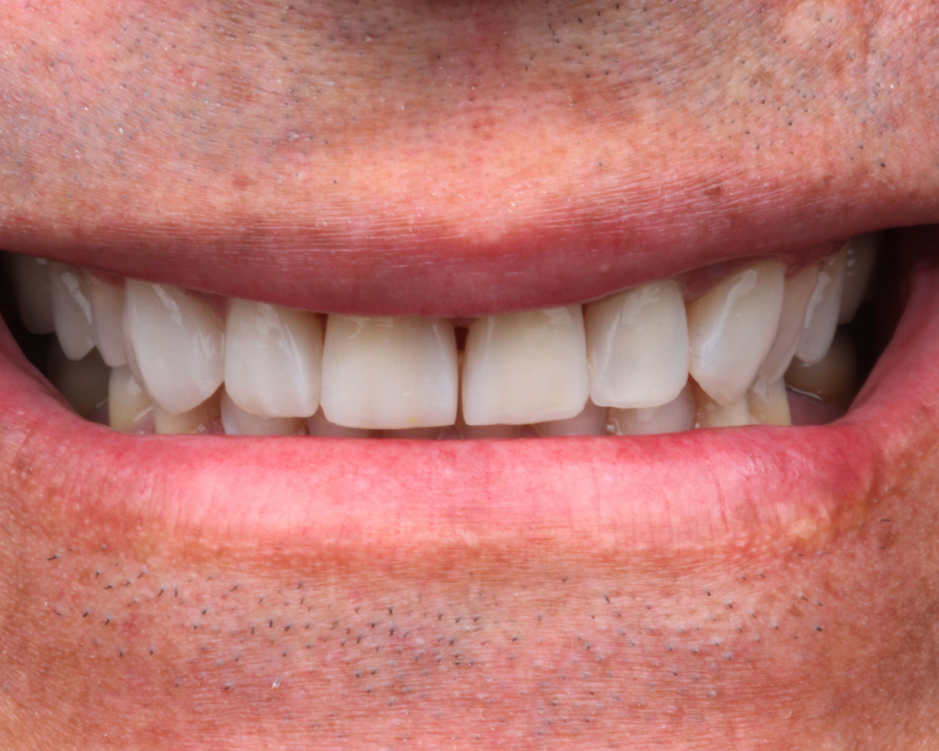 Depois - after smile