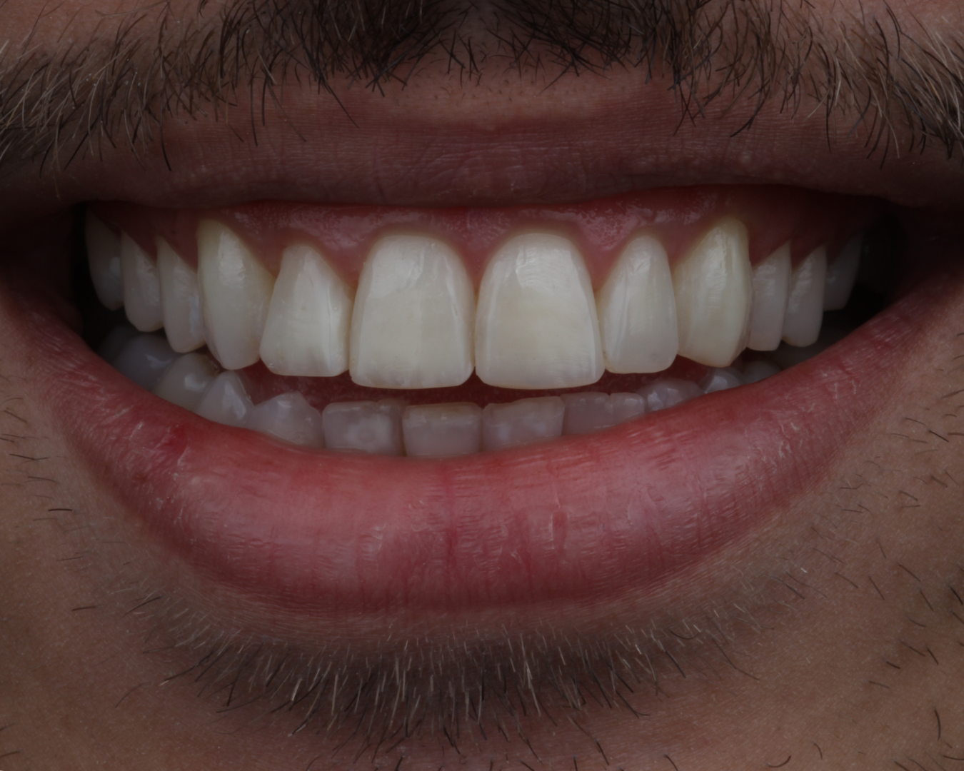 Depois - after smile