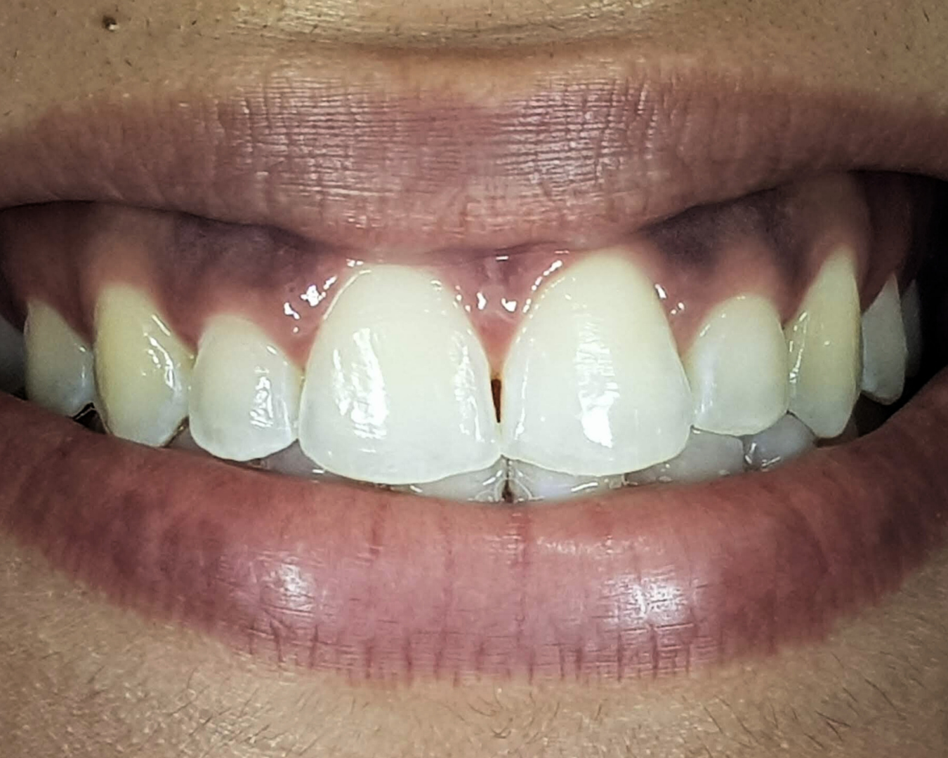 Antes - before smile